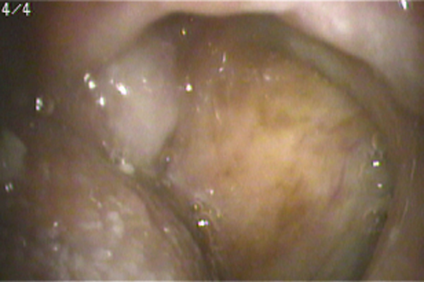 舌左縁の潰瘍を伴う舌癌