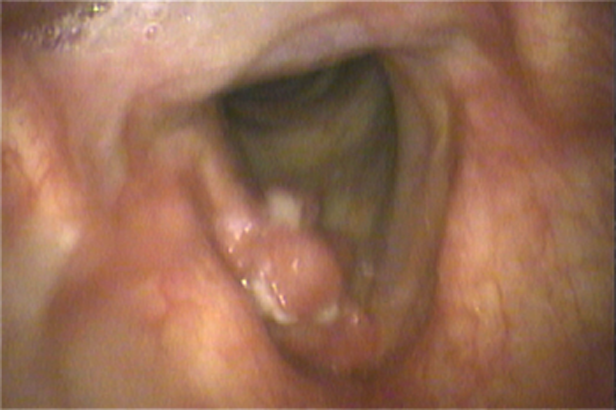 喉頭癌の喉頭ファイバー所見