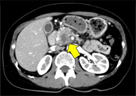 膵がん（膵頭部）CT画像