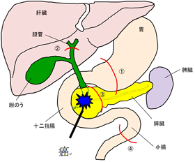 膵頭十二指腸切除