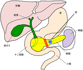 膵頭十二指腸切除