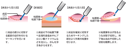 内視鏡的粘膜下層剥離術（ESD）