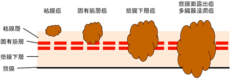 胆道の深達度