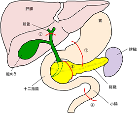 膵頭十二指腸切除