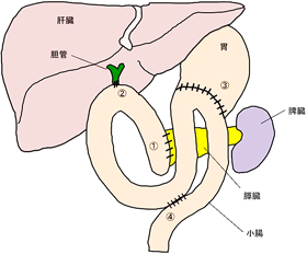 再建方法