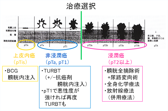 膀胱癌治療の必要性と治療法選択②