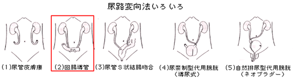 膀胱全摘除術+尿路変向術