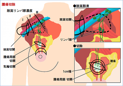 わき（腋窩）のリンパ節転移の評価