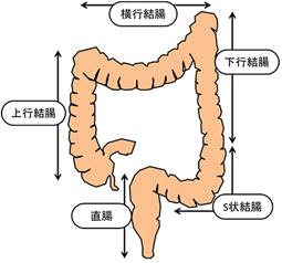 大腸がんとは