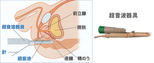 超音波器具