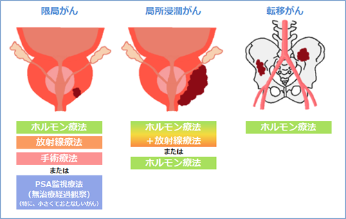 前立腺癌治療の必要性と治療法選択