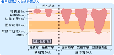 早期胃がんと進行胃がん