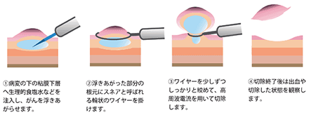 内視鏡的粘膜切除術（EMR）