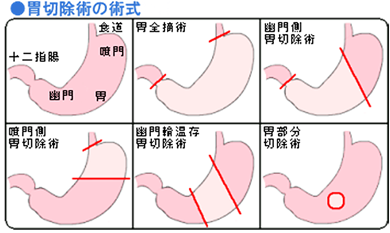 胃切除術の術式①