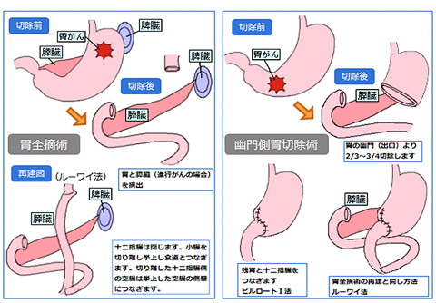 胃切除術の術式②