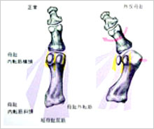 外反母趾②