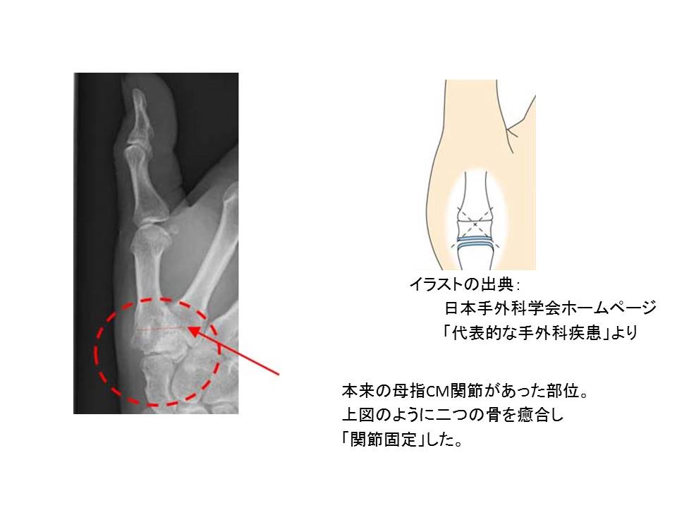 関節形成術①