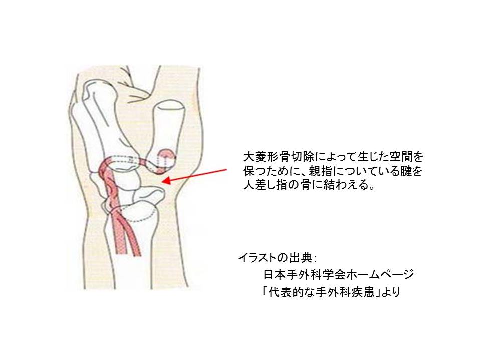 関節形成術③