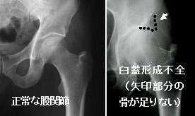 臼蓋形成不全①