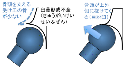 臼蓋形成不全②