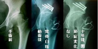 寛骨臼移動術①