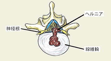椎間板ヘルニアとは