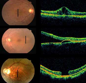 糖尿病黄斑浮腫・中心性漿液性網脈絡膜症・黄斑円孔