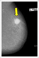 マンモグラフィ②
